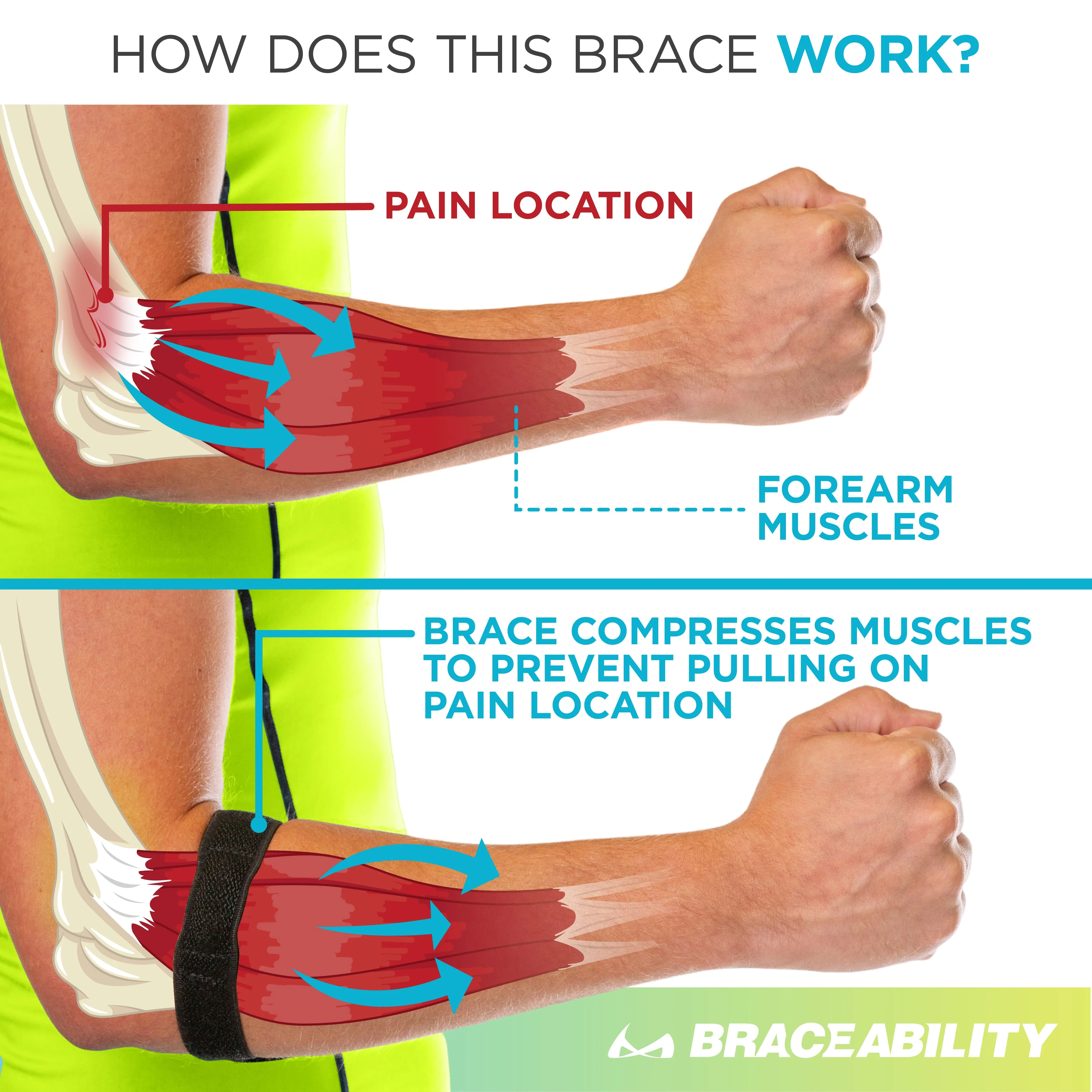 Epicondylitis Brace | Elbow Strap for Medial / Lateral Epicondyle Arm Pain & Tendonitis